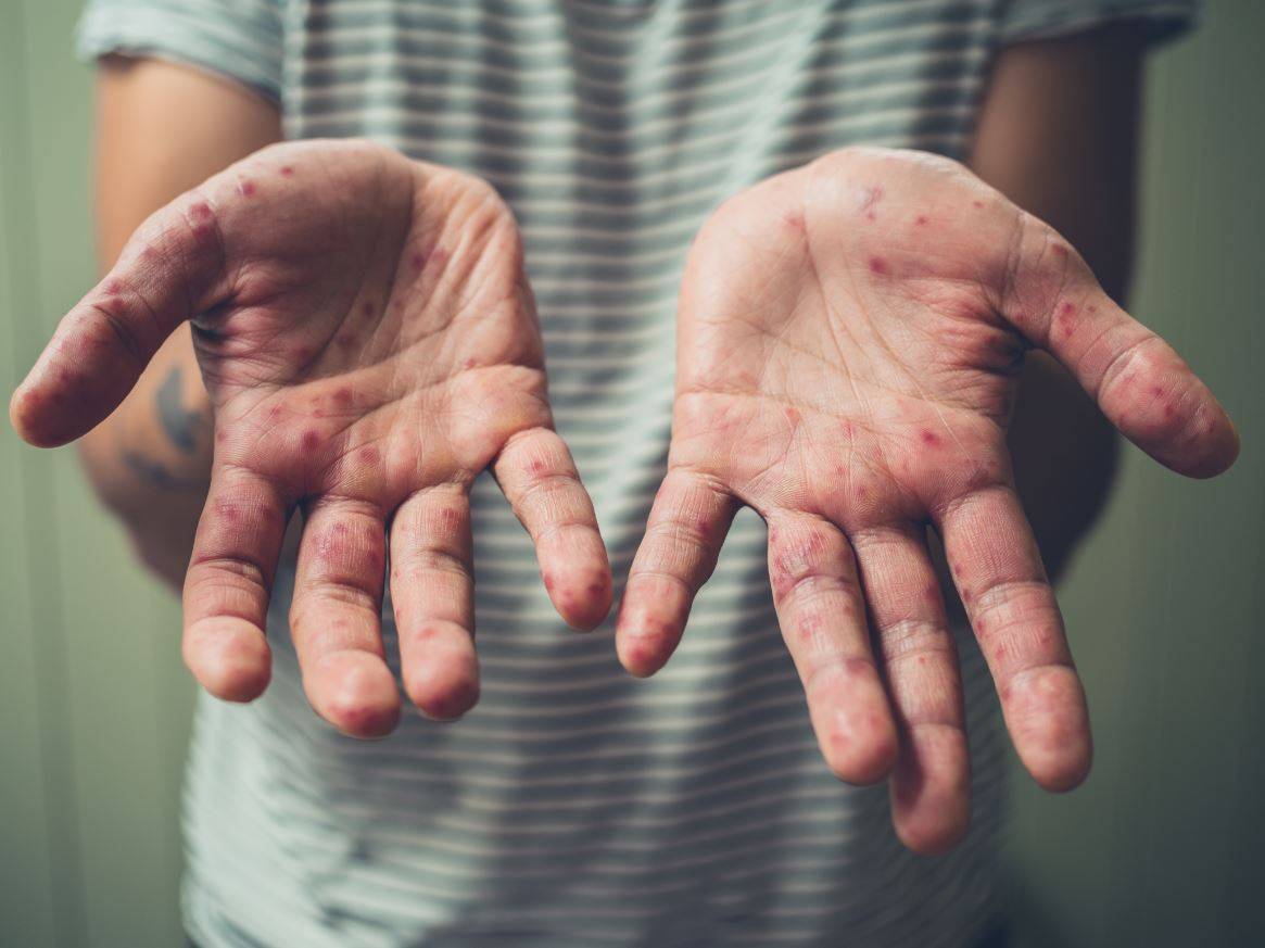 Why we should not lose the fear of measles