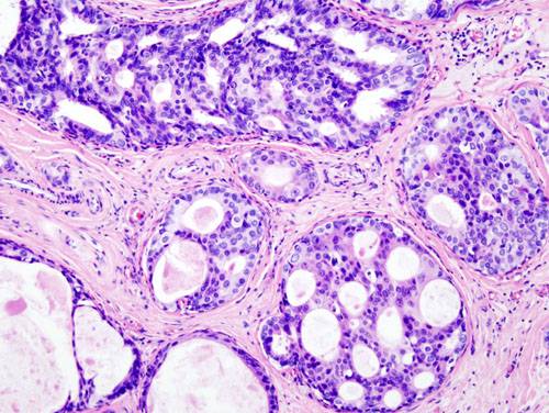 Imagen histopatológica de carcinoma ductal de mama. Imagen: Wikipedia.