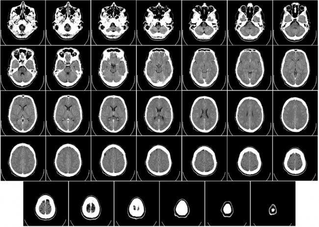 Tomografía Cerebral