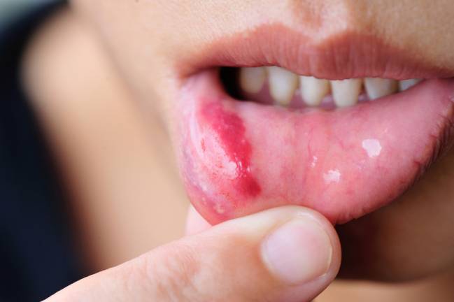 Labio con herpes simple. / Fotolia