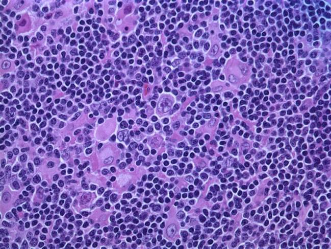 Linfoma de Hodgkin al microscopio. Imagen: Wikipedia