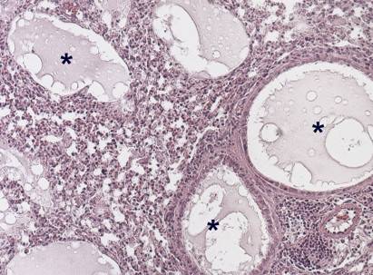 edema pulmonar