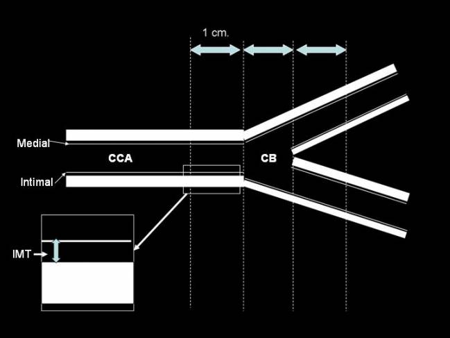 Ilustración mostrando el segmento de medición del grosor de la íntima media o intima media thickness (IMT) en la arteria carótida común