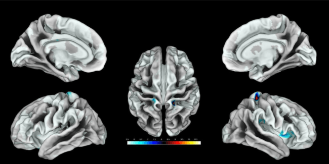 región del cerebro activada por estimulación del clítoris