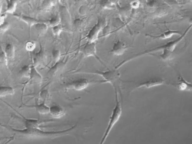 Investigadores del Instituto de Neurociencias de Castilla y León (INCYL) comprueban que un agente antitumoral que han patentado es efectivo en gliomas de pacientes