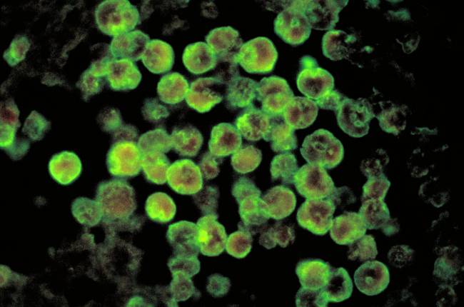 Histopatologia de la meningoencefalitis amébica
