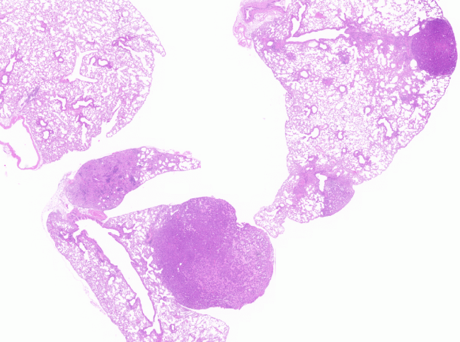 Tumor pulmonar