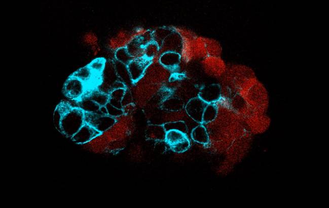 Organoide de tumor colorrectal