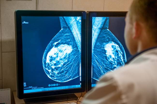 Las tasas de supervivencia a cinco años del cáncer de mama alcanzan ya el 86 %
