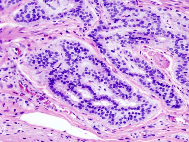 carcinoma de colon