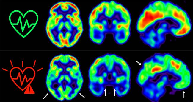 Consumo de glucosa en el cerebro de individuos según su riesgo cardiovascular