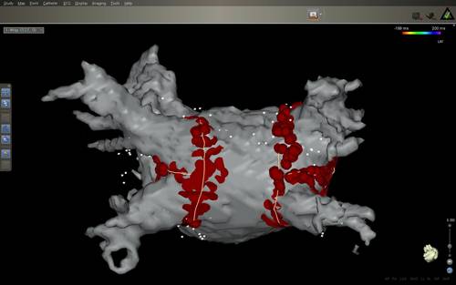 Un estudio demuestra la eficacia de la cirugía para tratar la fibrilación auricular