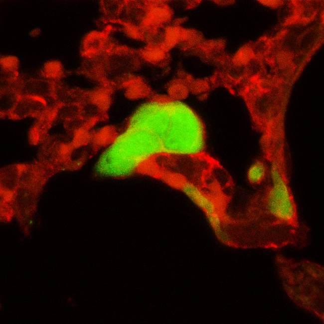 Nueva lesión de metástasis a pulmón procedente de una metástasis de hígado, desde un tumor original en el colon