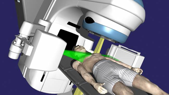 Ejemplo de radioterapia guiada por imagen / Varian Medical Systems, Inc.