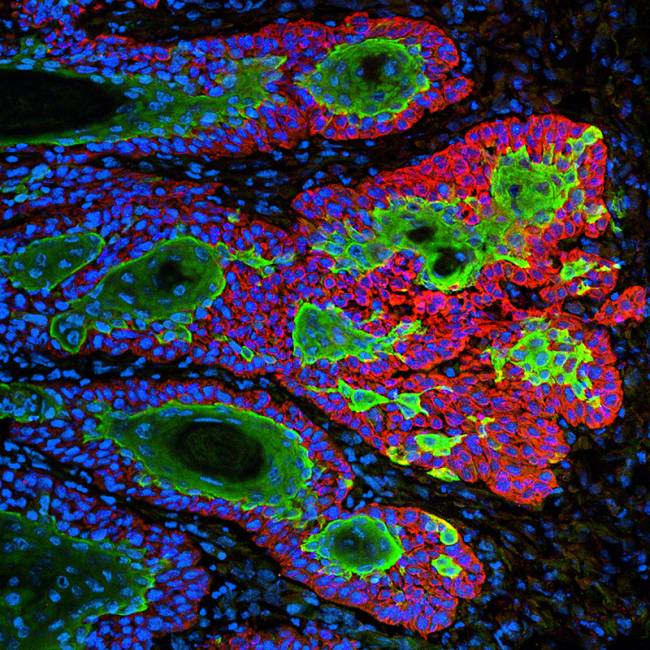 Carcinoma de células escamosas, un tipo muy común de cáncer de piel / Markus Schober and Elaine Fuchs, The Rockefeller University.