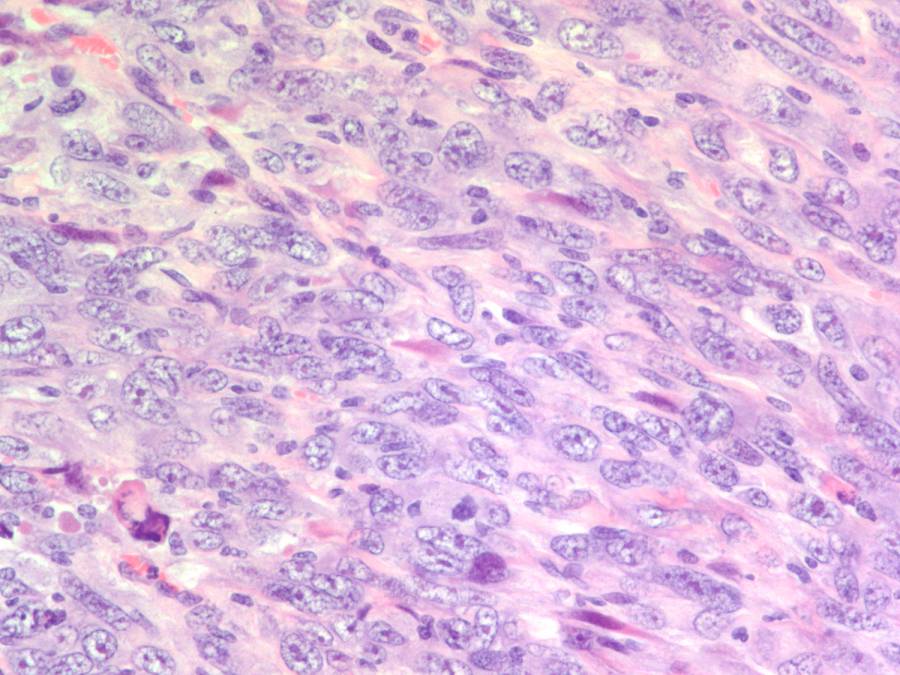 mesotelioma