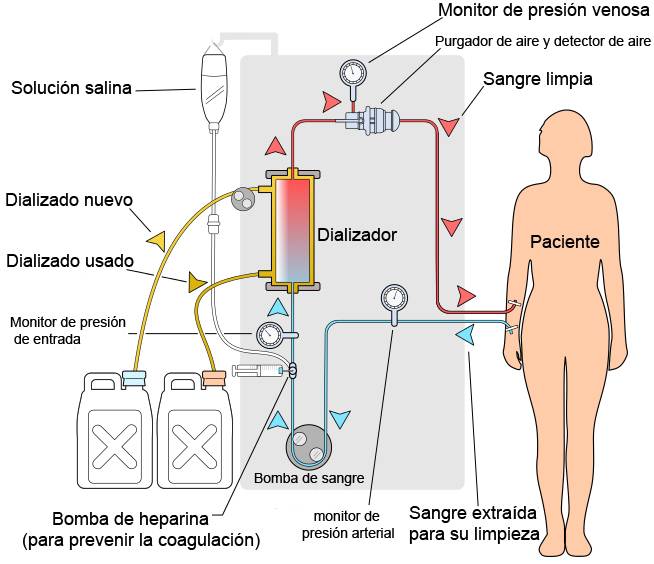 Diagrama esquemático de un circuito de hemodiálisis