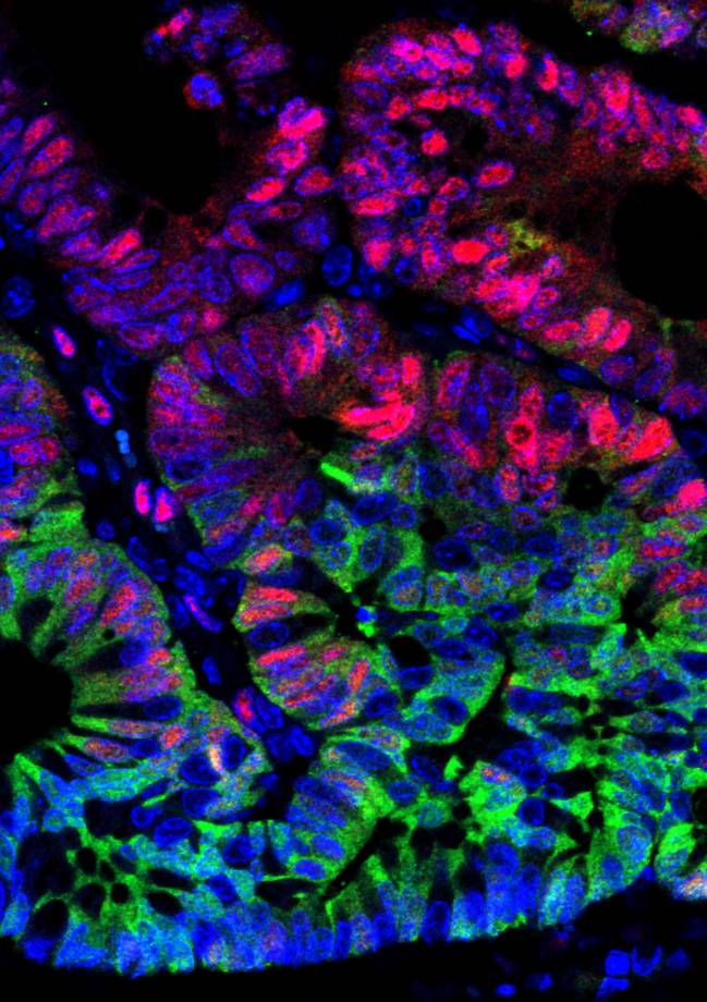 Tumor beningo de colon o adenoma (Imagen: Laboratorio de Cáncer Colorrectal)