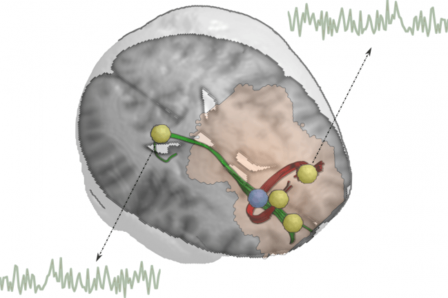 materia blanca en el cerebro