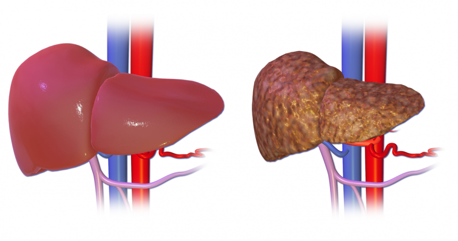 higado normal vs cirrosis