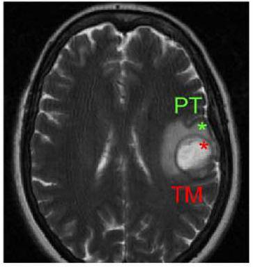 Cerebro afectado por un glioblastoma