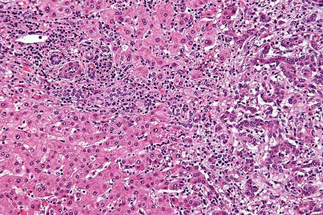 Microfotografía de un colangiocarcinoma intrahepático (derecha). Imagen: Wikipedia.