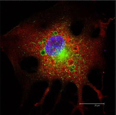 Células de glioblastoma tratatadas con THC