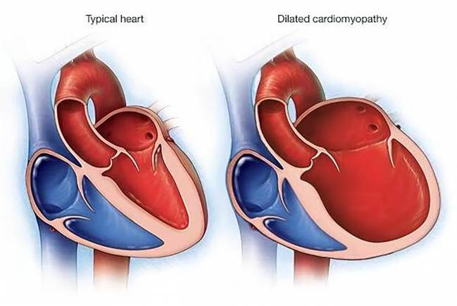 cardiopatía dilatada