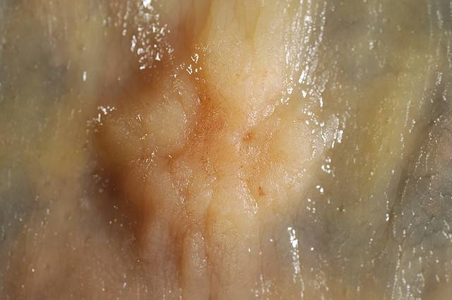 Adenocarcinoma de colon