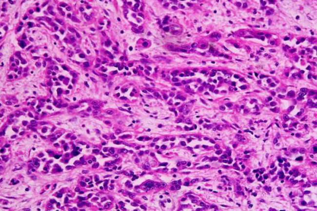 Adenocarcinoma de estómago. / Kwz-commonswiki