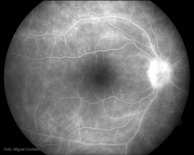 La uveítis es una inflamación del ojo.