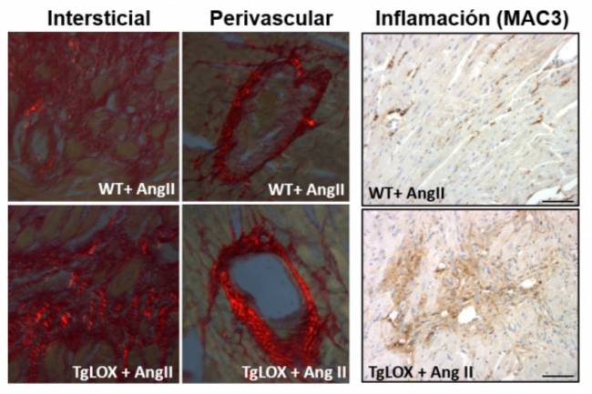 En el miocardio de los ratones transgénicos para la lisil oxidasa (TgLOX), la administración de Angiotensina II (AngII) aumenta el nivel de colágeno maduro (visualizado como refringencia roja) frente a los animales normales (WT). Los animales transgénicos presentan además mayor inflamación (paneles de la derecha)