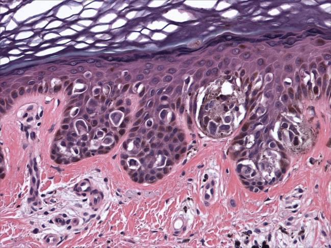 melanoma
