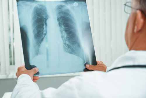 La hipertensión pulmonar es una enfermedad que se caracteriza por el aumento anómalo de la presión sanguínea. / Fotolia