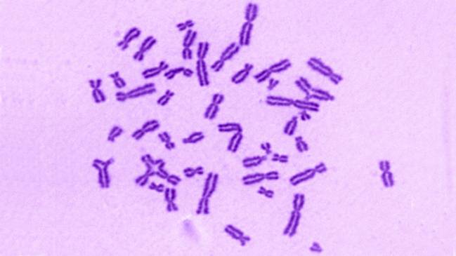 deficiente producción de células sanguíneas en anemia de Fanconi