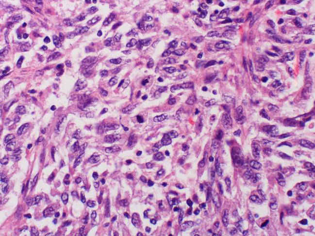 Células metastáticas de malanoma