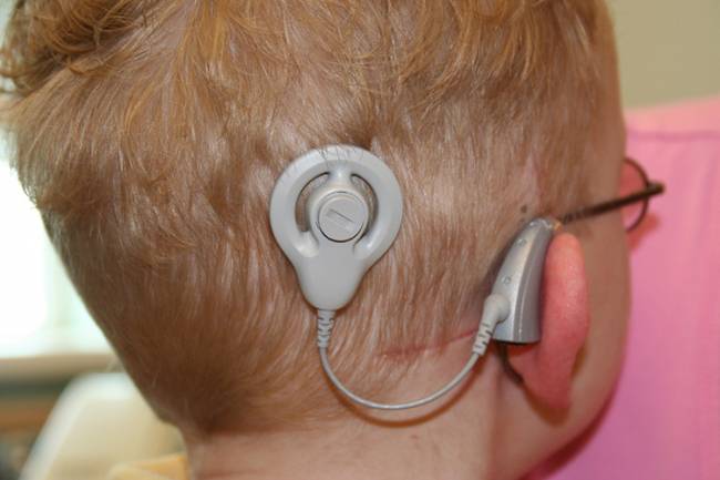 El beneficio de los implantes cocleares depende, entre otros factores, de la edad de implantación. / Ryanjpoole.