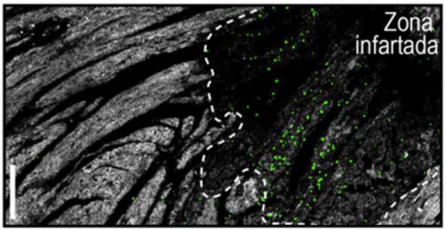 neutrófilos, daño cardiaco, infarto