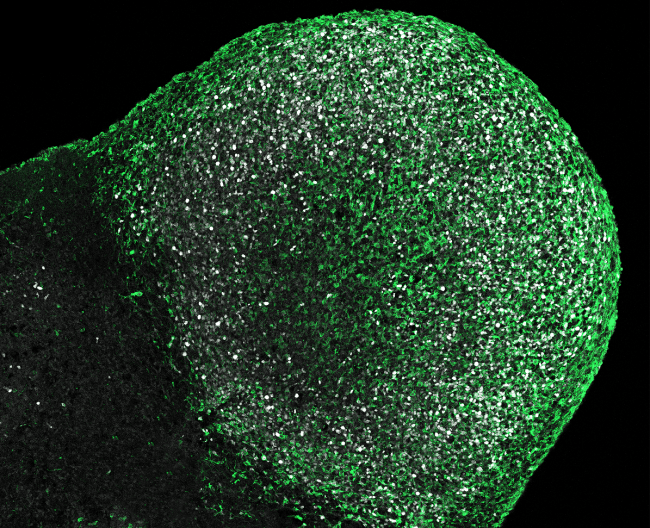 Organoide derivado de un paciente con esclerosis tuberosa