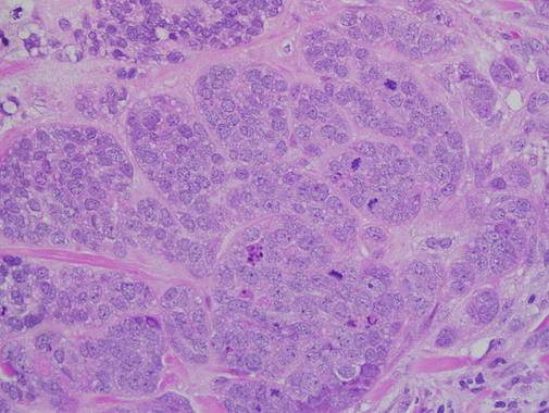 Mecanismo de acción de la primera nanoterapia basada en el uso de un anticuerpo no modificado dirigido contra una proteína intracelular. /UAM-USC