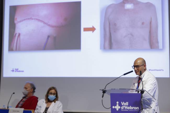 El jefe de Servicio de Cirugía Torácica y Trasplante Pulmonar de Vall d'Hebron, Albert Jauregui, durante la rueda de prensa