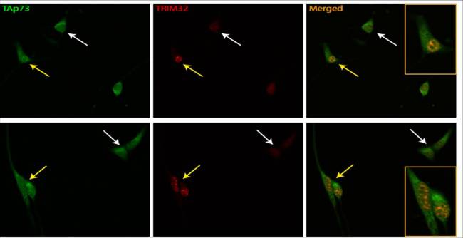 TP73 y TRIM32 están implicados en enfermedades neurodegenerativas como alzhéimer y párkinson y en el cáncer