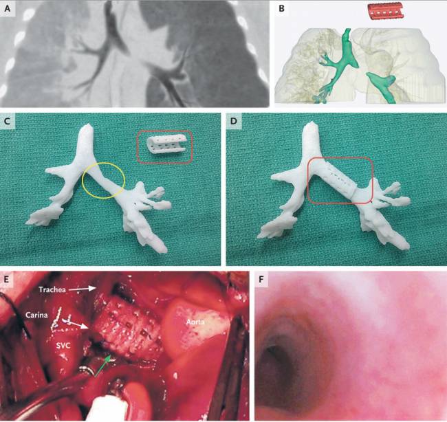 La férula fue creada con un biomaterial reabsorbible por el cuerpo en tres años. / NEMJ
