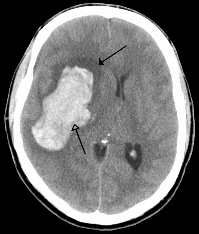accidente cerebrovascular