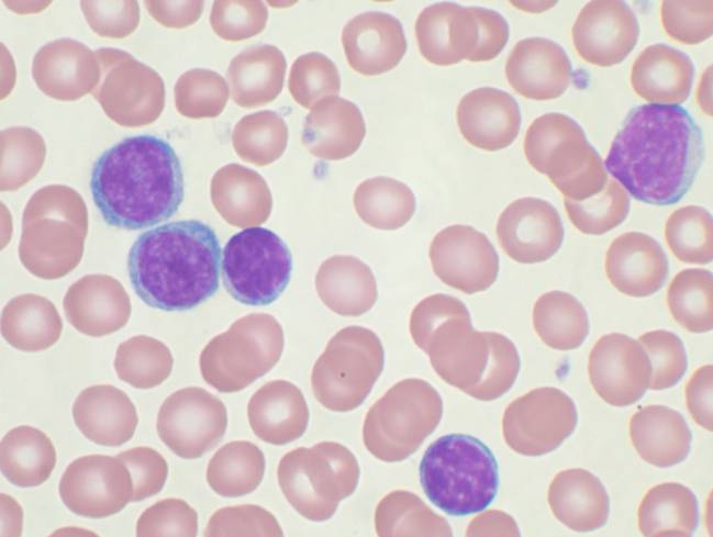 leucemia linfática cronica