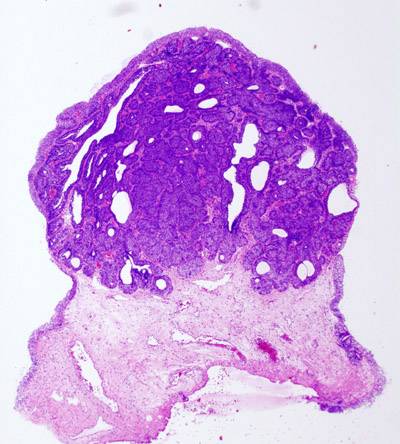 tumor vejiga