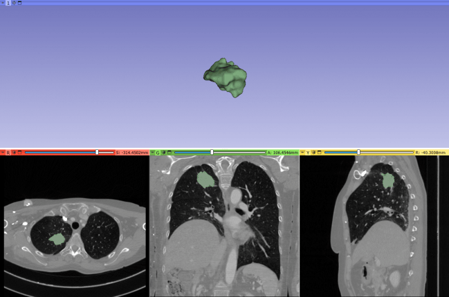 Nuevo biomarcador para predecir el beneficio clínico de la inmunoterapia en pacientes de cáncer de pulmón