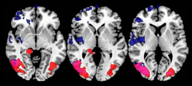 Escáner del cerebro que muestra la plasticidad cerebral