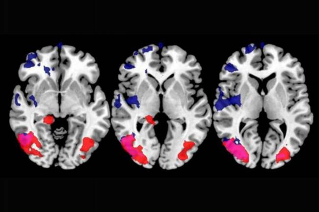 Escáner del cerebro que muestra la plasticidad cerebral