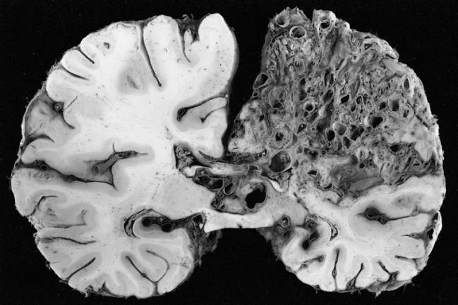 Deformación arteriovenosa en el hemisferio izquierdo típica de la enfermedad. / Wikipedia